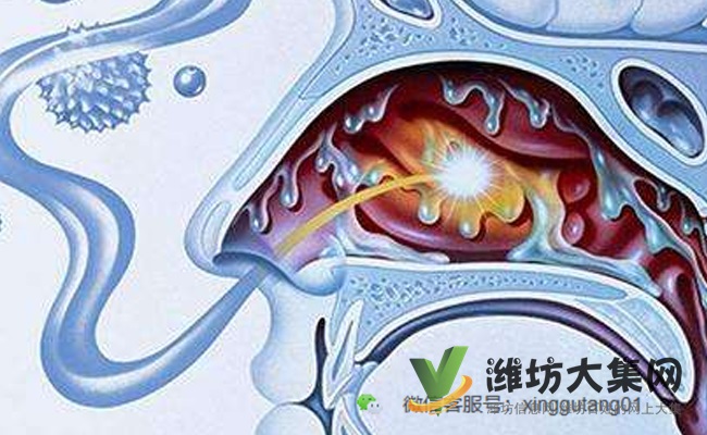 鼻炎是如何慢慢扼殺您的健康的?得了鼻炎怎么治?
